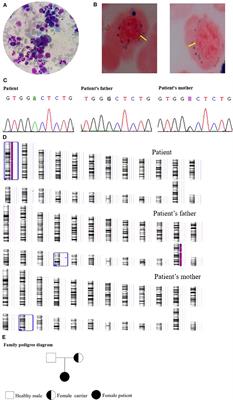 Case Report: Genetic and Clinical Features of Maternal Uniparental Isodisomy-Induced Thiamine-Responsive Megaloblastic Anemia Syndrome